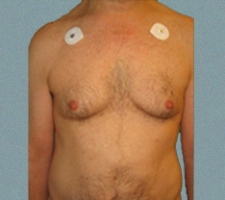 patient5_before2