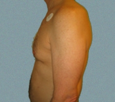 patient5_before3