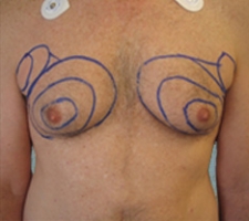 patient5_before4_drawing