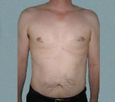 Male Breast Patient 6