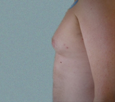 patient6_before2