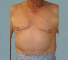 Male Breast Patient 7