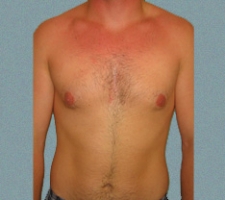 Male Breast Patient 8