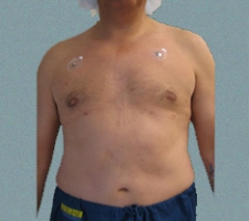 Male Breast Patient 9