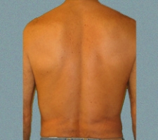 Male Flanks Patient 2