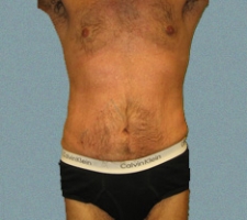 Male Flanks Patient 3