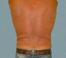 Male Flanks Patient 4
