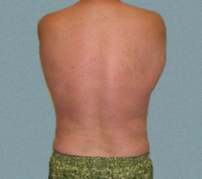 Male Flanks Patient 5