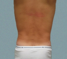 Male Flanks Patient 6