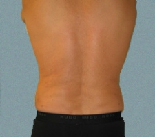 Male Flanks Patient 9