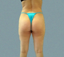 Outer Thigh Patient 1