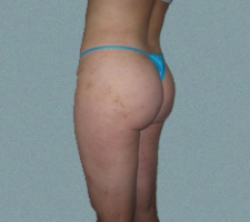Outer Thigh Patient 10