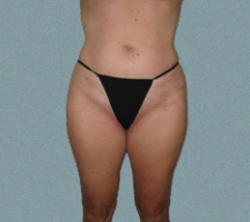 Outer Thigh Patient 11