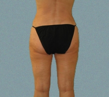 Outer Thigh Patient 13