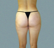 Outer Thigh Patient 14
