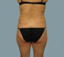 Outer Thigh Patient 15