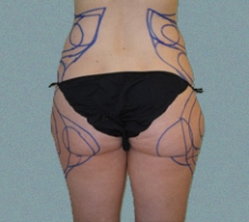 Outer Thigh Patient 16