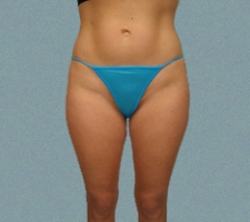Outer Thigh Patient 17