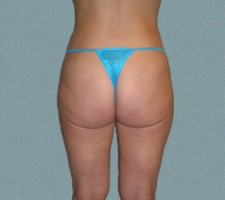 Outer Thigh Patient 18
