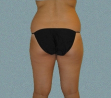 Outer Thigh Patient 19