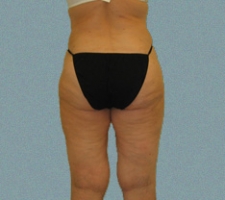 Outer Thigh Patient 2