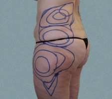 patient2_before3_drawing