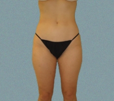 Outer Thigh Patient 20