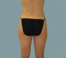 patient20_after2_3months