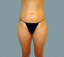 Outer Thigh Patient 3