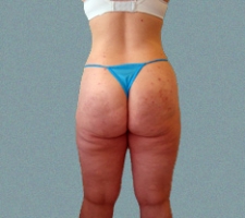 Outer Thigh Patient 4