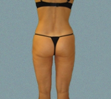 Outer Thigh Patient 5