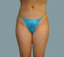 Outer Thigh Patient 6
