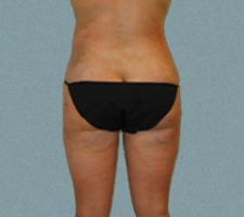 Outer Thigh Patient 7