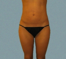 Outer Thigh Patient 9