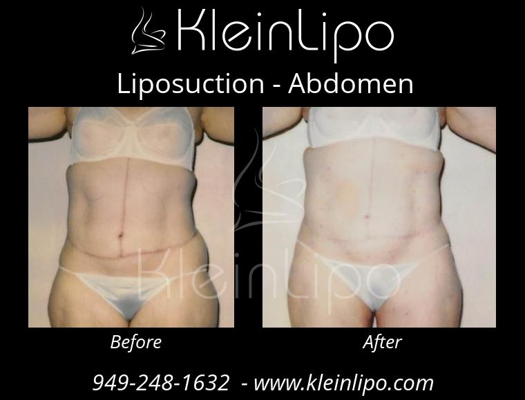 Liposuction-Abdomen-2-27-2018-16-54-28