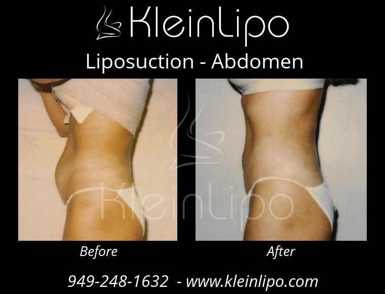 Liposuction-Abdomen-2-27-2018-16-54-31