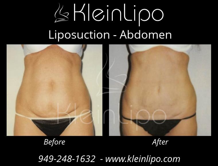 Liposuction-Abdomen-2-27-2018-16-54-32