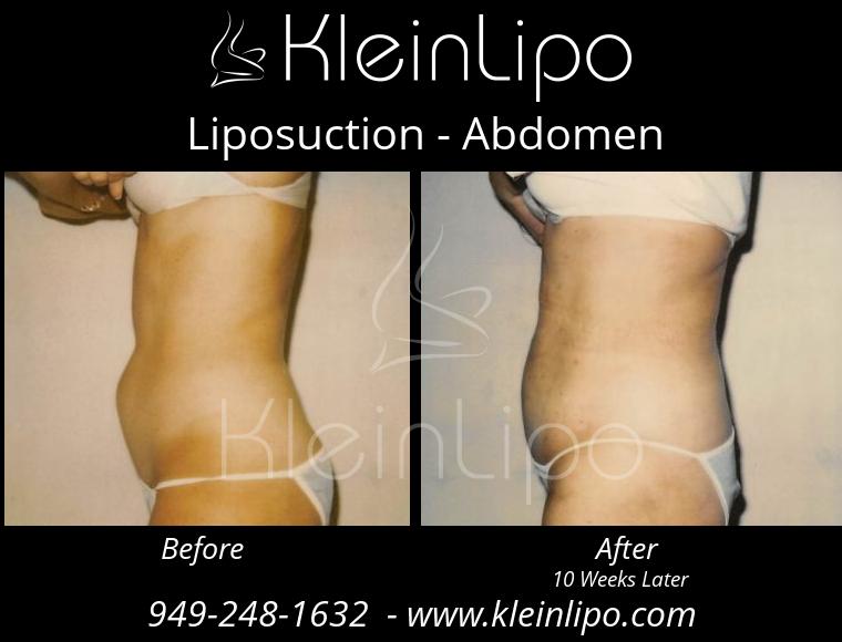 Liposuction-Abdomen-2-27-2018-16-54-44