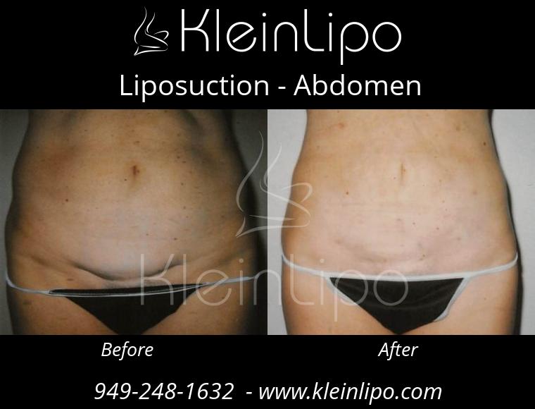 Liposuction-Abdomen-2-27-2018-16-54-48