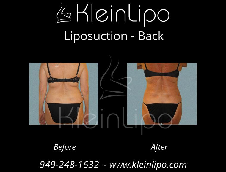 Liposuction-Back-2-27-2018-18-08-29