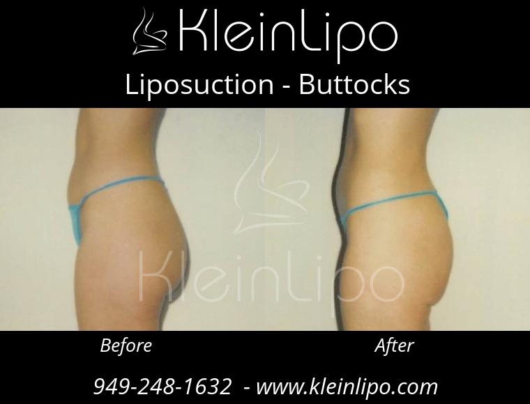 Liposuction-Buttocks-2-27-2018-16-52-11