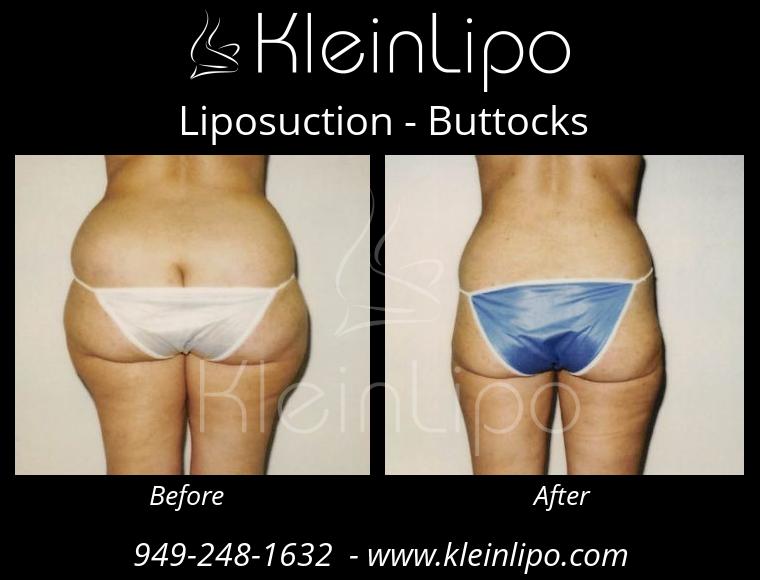 Liposuction-Buttocks-2-27-2018-16-52-17