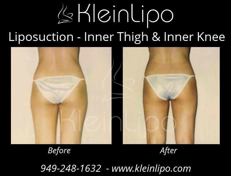 Liposuction-InnerThigh&InnerKnee-2-27-2018-16-42-05
