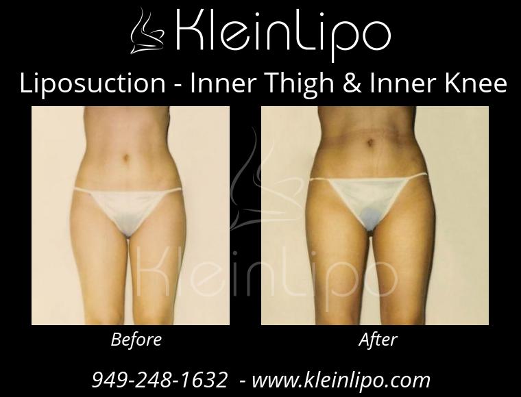 Liposuction-InnerThigh&InnerKnee-2-27-2018-16-42-23