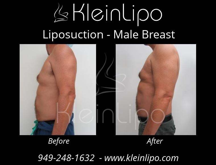 Liposuction-MaleBreast-2-27-2018-17-53-14