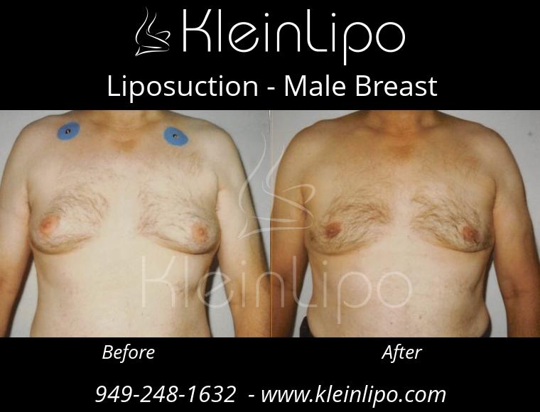 Liposuction-MaleBreast-2-27-2018-17-53-19