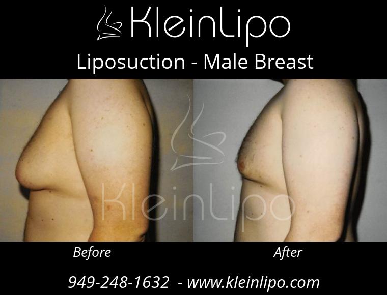 Liposuction MaleBreast 2 27 2018 18 41 24
