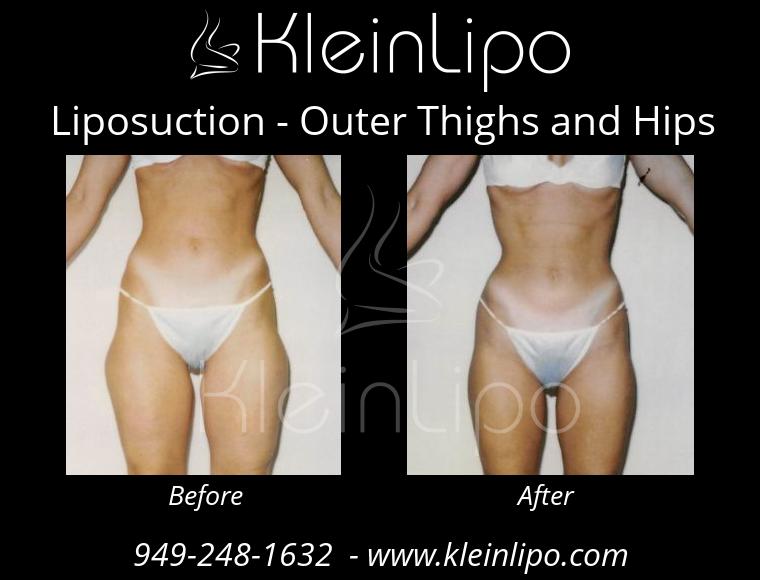 Liposuction OuterThighsandHips 2 27 2018 16 44 45